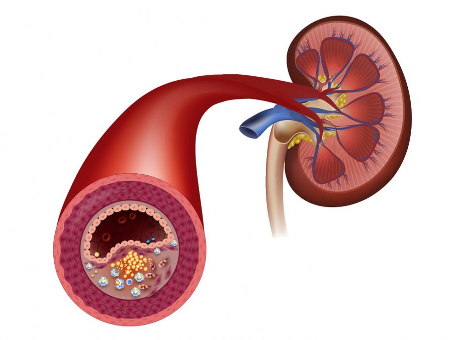 Decreased blood flow due to atherosclerosis